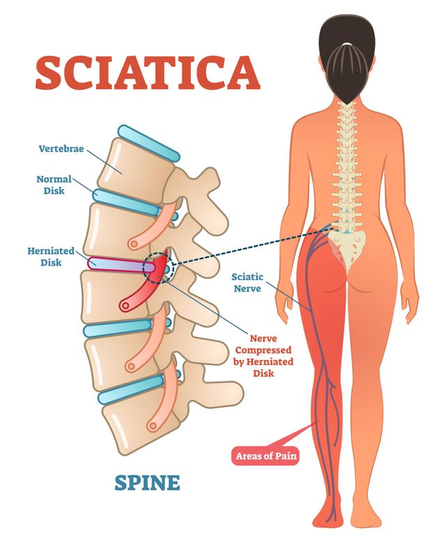 Magnetic Resonance Imaging for Back Pain